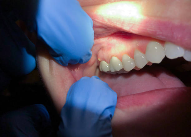 Best Emergency Dental Care for Broken or Chipped Teeth in Oak Creek, WI